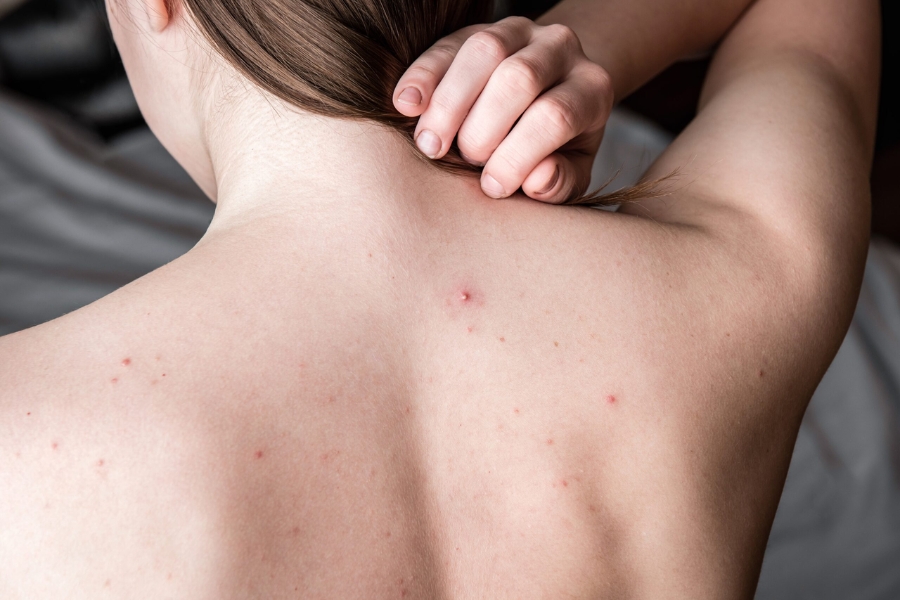 Minh họa mụn đầu trắng và mụn đầu đen ở vùng da lưng